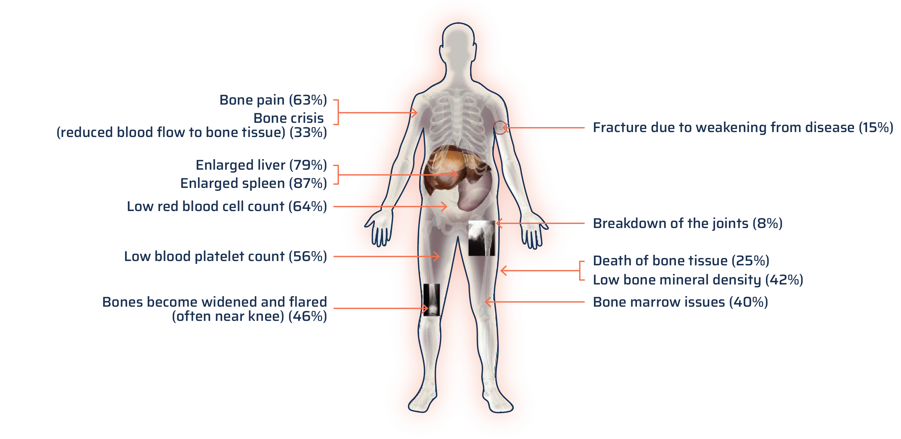 A person is shown in a medical illustration with their internal organs and bones revealed. The liver and spleen are highlighted as are the knee and hip joints. This visual shows the percent of people with Type 1 Gaucher disease who reported each symptom: Bone pain 63% [points to arm bone]; bone crisis (reduced blood flow to bone tissue) 33% [points to arm bone]; enlarged spleen 87% [points to organs cutaway]; enlarged liver 79% [points to organs cutaway]; low red blood cell count 64% [points to organs cutaway]; low blood platelet count 56% [points to leg muscle]; bones become widened and flared (often near knee) 46% [points to knee x-ray]; fracture due to weakening from disease 15% [points to arm bone]; freakdown of the joints  8% [points to hip x-ray]; death of bone tissue 25% [points to leg x-ray]; low bone mineral density 42% [points to leg x-ray]; bone marrow issues 40% [points to leg bone].