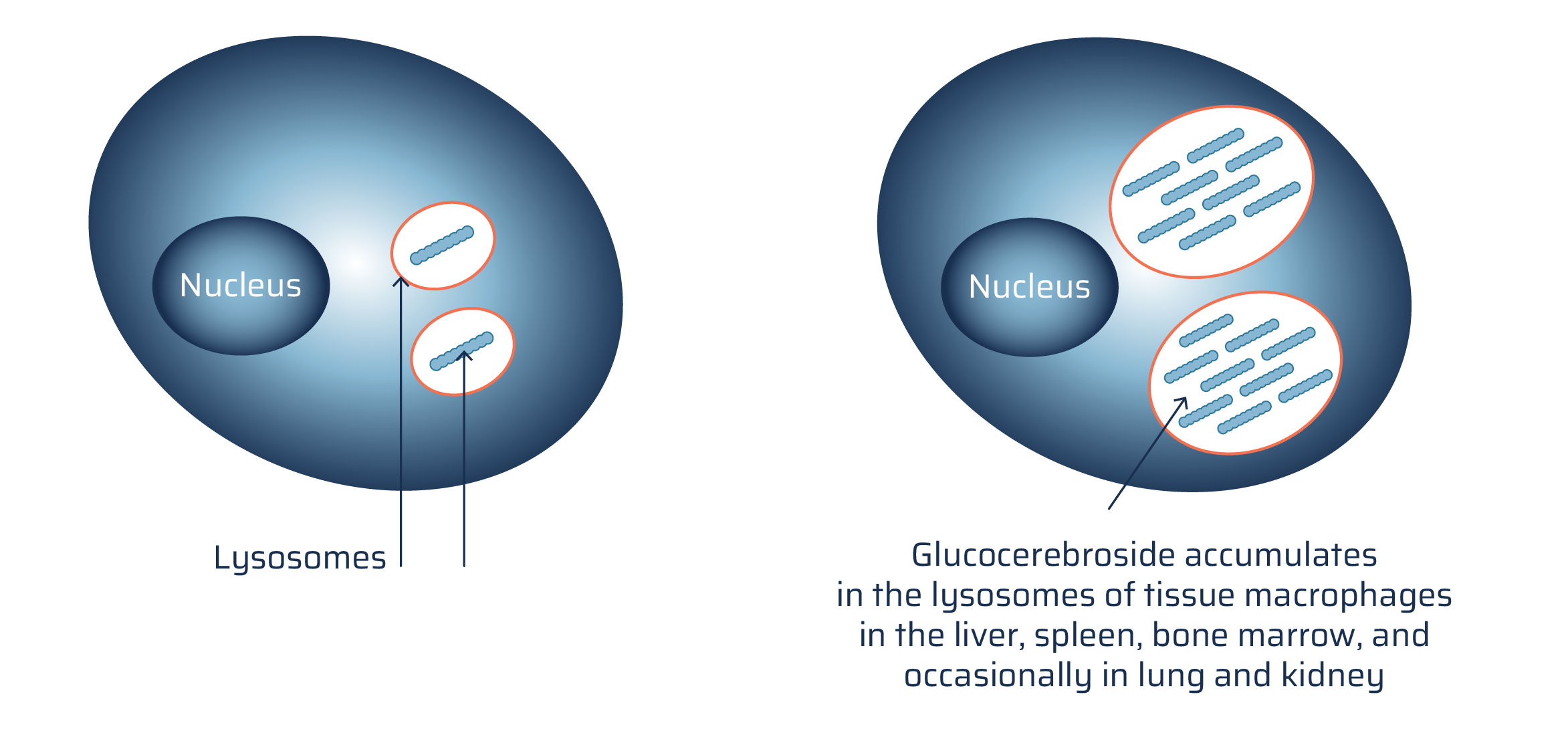 A normal macrophage cell is compared with a macrophage cell with Gaucher disease. The normal macrophage cell is oblong and purple and contains an oblong nucleus, and two oblong lyosomes. The macrophage cell with Gaucher disease differs from the normal macrophage cell because glucocerebroside accumulates in the lyosomes. The caption reads: glucocerebroside accumulates in the lyosomes of tissue macrophages in the liver, spleen, bone marrow, and occasionally in lung and kidney.