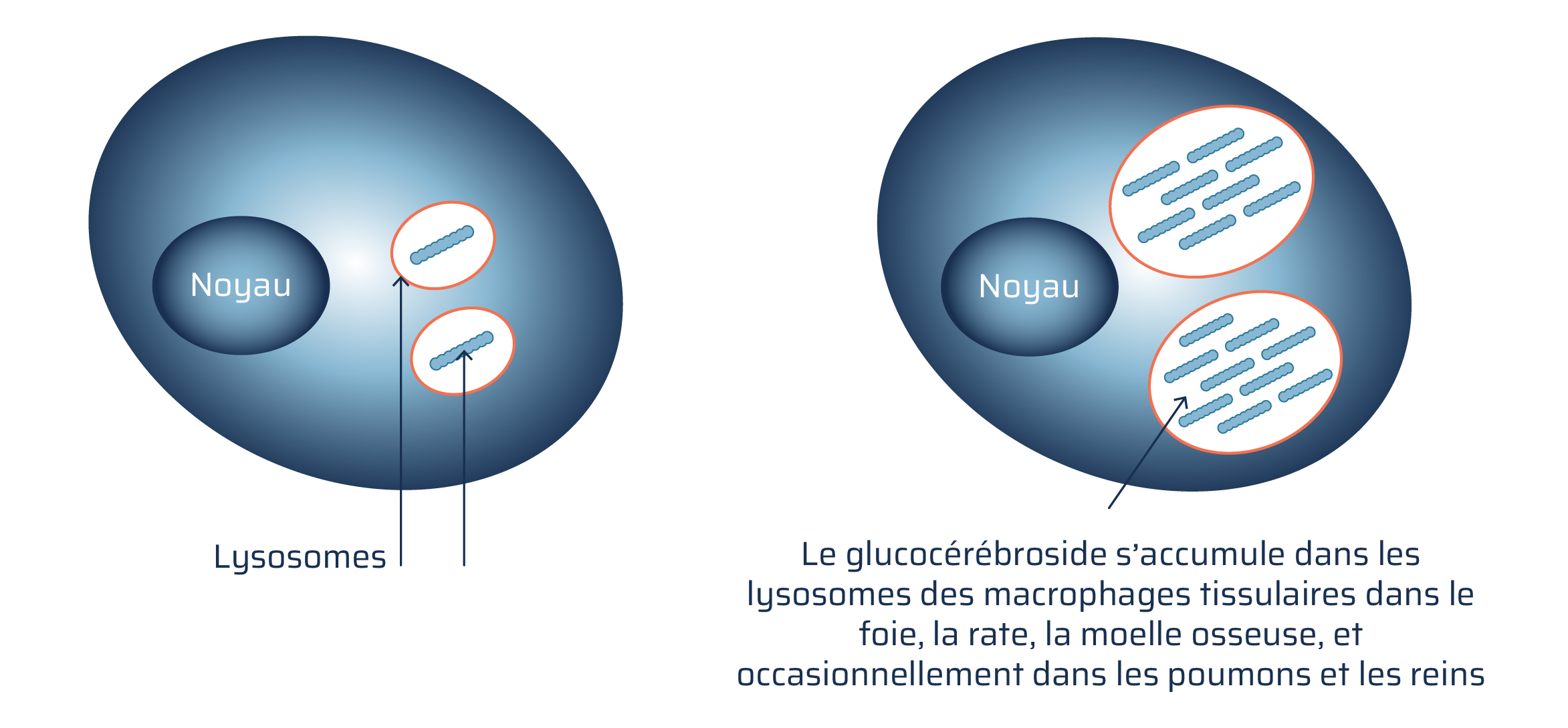 Un macrophage normal est comparé à un macrophage atteint de la maladie de Gaucher. Le macrophage normal est oblong, violet, et contient un noyau oblong ainsi que deux lysosomes oblongs. Le macrophage atteint de la maladie de Gaucher diffère du macrophage normal parce que le glucocérébroside s’accumule dans les lysosomes. La légende indique : le glucocérébroside s’accumule dans les lysosomes des macrophages tissulaires du foie, de la rate, de la moelle osseuse et parfois dans les poumons et les reins.