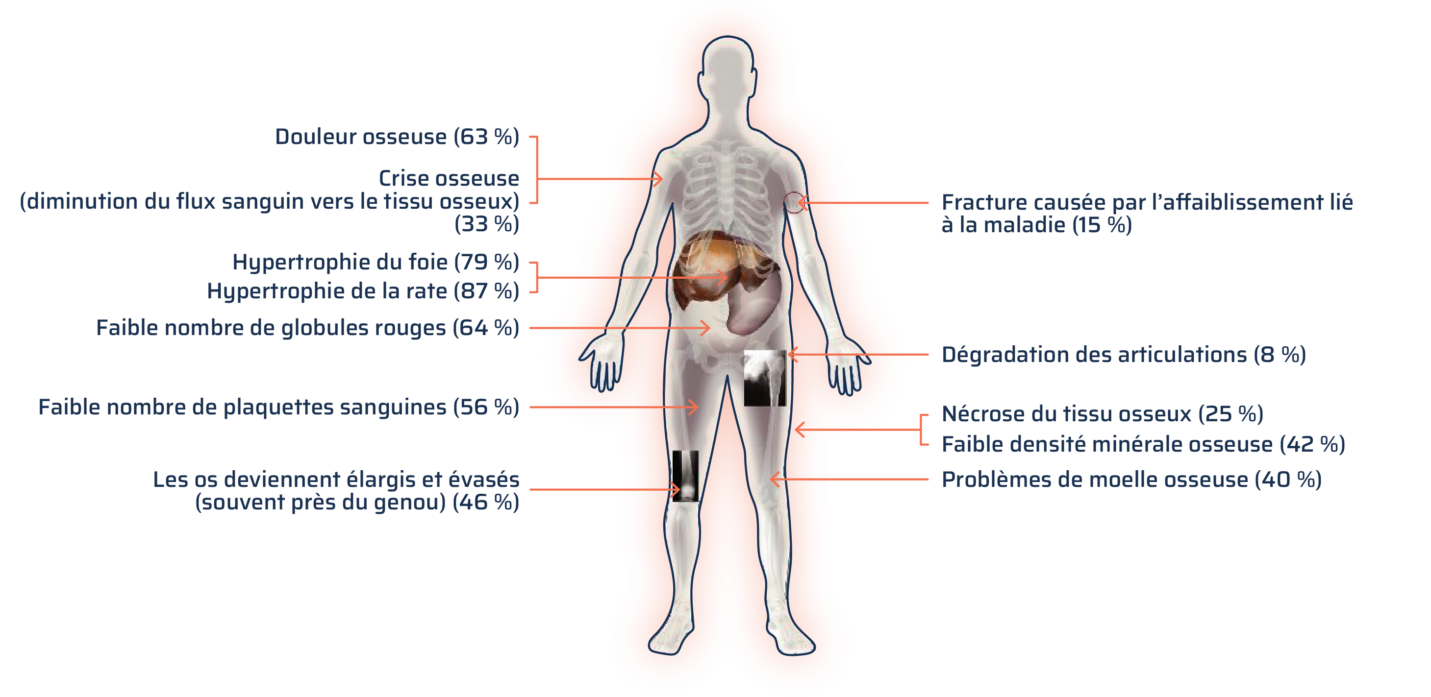 Une personne est représentée dans une illustration médicale avec ses organes internes et ses os visibles. Le foie et la rate sont mis en évidence, de même que les articulations du genou et de la hanche. Cette illustration montre le pourcentage de personnes atteintes de la maladie de Gaucher de type 1 ayant déclaré chacun des symptômes suivants :  Douleur osseuse 63 % [pointe vers l’os du bras]; crise osseuse (diminution du flux sanguin vers le tissu osseux) 33 % [pointe vers l’os du bras]; hypertrophie de la rate 87 % [pointe vers les organes visibles dans la coupe]; hypertrophie du foie 79 % [pointe vers les organes visibles dans la coupe]; faible nombre de globules rouges 64 % [pointe vers les organes visibles dans la coupe]; faible numération plaquettaire 56 % [pointe vers le muscle de la jambe]; les os deviennent élargis et évasés (souvent près du genou) 46 % [pointe vers la radiographie du genou]; fracture due à l’affaiblissement causé par la maladie 15 % [pointe vers l’os du bras]; dégradation des articulations 8 % [pointe vers la radiographie de la hanche]; nécrose du tissu osseux 25 % [pointe vers la radiographie de la jambe]; faible densité minérale osseuse 42 % [pointe vers la radiographie de la jambe]; problèmes de moelle osseuse 40 % [pointe vers l’os de la jambe].